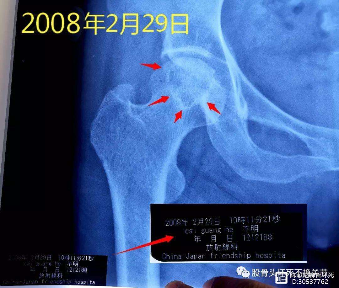 上饶人工骨头医保报销多少(人工骨头医保报销多少比例)